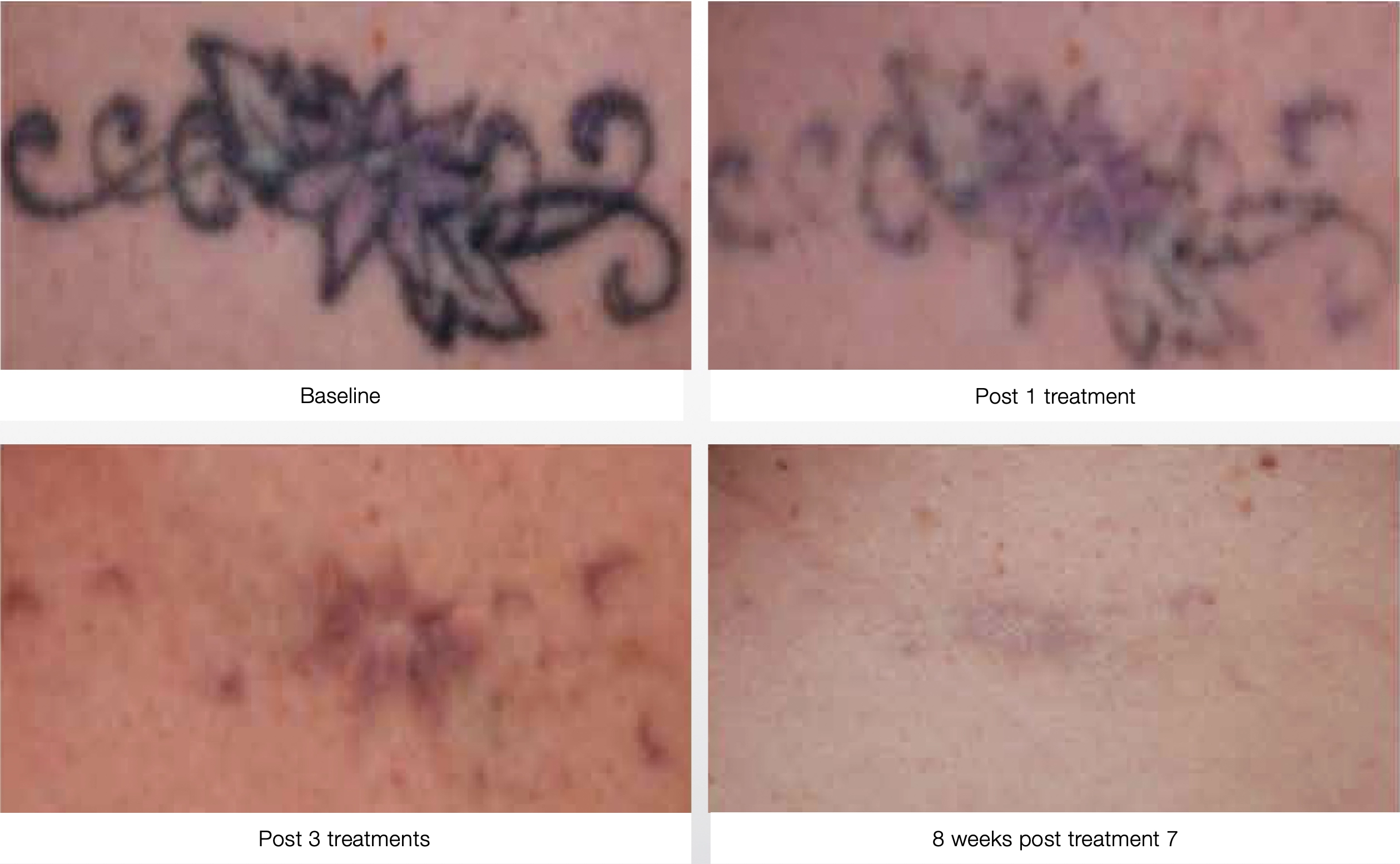Best Laser Tattoo Removal | Skin Clinic NY - Bared Monkey